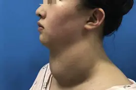 21 年来见到的最大的甲亢，严重压迫气管，危及生命图片