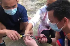 女子学抖音戒指开啤酒，手指红肿险坏死图片