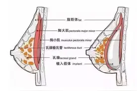 假体丰胸手术为何会疼痛感这么强烈？图片