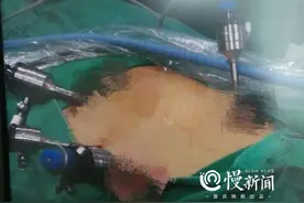 慢生活·健康丨女子怕留疤不想手术，医生微创打孔切除囊肿：“你要的‘美’，我们给！”图片