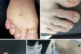 新冠病毒致脚上起痘？专家：或是无症状感染者早期预警信号图片