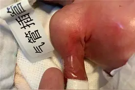 新生儿体重1斤多，“胳膊还没手指粗”，83天后奇迹发生图片