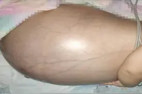 1岁娃肚子胀成皮球大，做了推拿按摩不见效没想到竟是巨大肿瘤图片