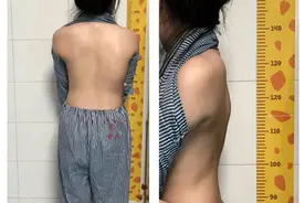 脊柱侧弯8年后被“掰”直，东莞一女子增高4厘米图片