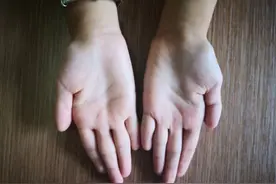 8岁女孩患上发病率百万分之一的罕见病图片