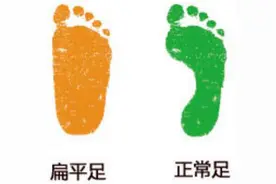 8岁前治疗扁平足 或许可以不用做手术图片