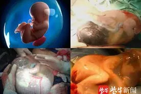 很罕见：宝宝出生有完整羊膜囊“护体”，就像一个“巨型透明鸡蛋”图片