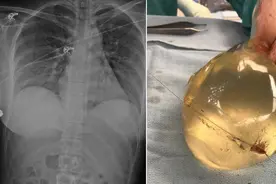 加拿大女子街头突遭枪击，子弹击中隆胸硅胶救了她一命图片
