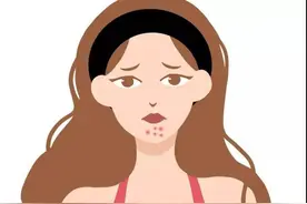 下巴长出的白色颗粒物，是什么？用一物可去除，成本两块钱图片