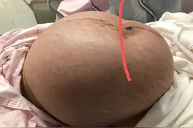 19岁少女未婚生子未产检，进产房才知腹内肿瘤比宝宝还大图片