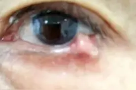 青岛一老人眼睑长疙瘩一碰就出血 眼科医生提醒：不能忽视图片