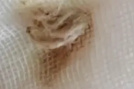 2岁女童下体出血还有异味？！母亲怀疑性早熟 医生一查惊了图片