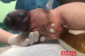宝宝刚一出生就头顶个“大包”，危及生命！只因妈妈孕期忽视了这件事图片