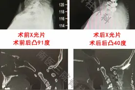 花季少女脖子后凸超90度 患的是罕见遗传病图片