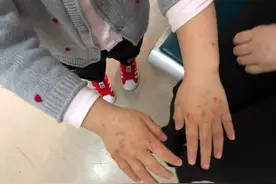 医院就诊湿疹过敏患者增加，洗手不必“太勤”，及时擦护手霜图片