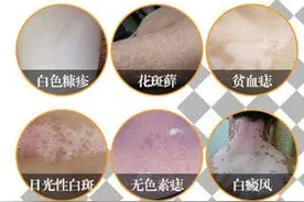 注意！这种疾病夏天多发容易和白癜风误诊图片