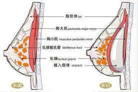 假体隆胸术后手感差，隆胸手感也是一门学问图片