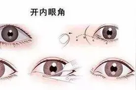 想割双眼皮，我这样的眼睛适合开内眼角还是外眼角？图片