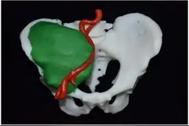 医生为他重建了3D打印的个性化骨盆！骨关节部位肿瘤患者有了新的治疗方式图片