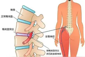 上海长征医院史国栋：腰椎间盘突出是怎么引起的？图片
