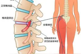 上海长征医院史国栋：腰椎间盘突出是怎么引起的？图片