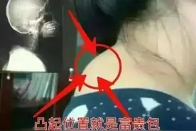 脖子后面的“富贵包”很多人都有，实则是个“夺命包”不得不重视图片