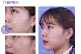 做了激光祛斑，竟然“返黑”了图片