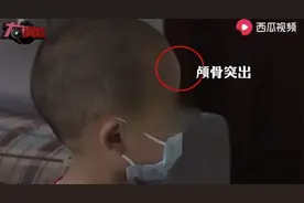 郴州“大头娃娃”再现，免疫学专家：长期食用固体饮料，无法保障婴儿成长所需成分图片