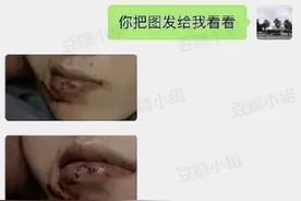 网曝范丞丞洗澡摔倒磕破下巴 最新出镜照伤口明显图片