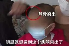 郴州永兴回应“大头娃娃”事件：有初步调查结果，患儿已再次体检图片