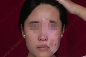 枣庄白癜风康复患者宋天骄：无人能阻挡我盼望美丽的梦想图片