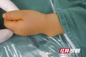 惊！2岁男童患腱鞘囊肿图片