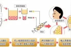 自体脂肪填充你了解多少？图片