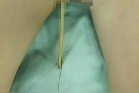 3岁女童被竹签刺入，抱来时……家长千万要注意图片