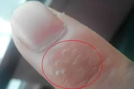 瘙痒难忍！姑娘手指长满小水泡还脱皮，医生：这症状夏天高发图片