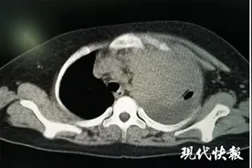 11岁男孩左肺离奇“消失”，医生惋惜：是罕见恶性肿瘤，晚期图片