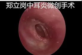鼓膜边缘穿孔，耳内镜微创巧解决图片