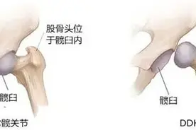 换人工关节，我差点逃出手术室图片
