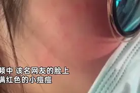 姑娘满脸红痘竟是长了脚气？爱“吸猫”的人一定要当心图片