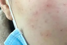 注意！戴口罩又化妆真的会烂脸图片