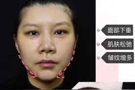 网红、女明星都喜欢做的面部埋线提升，究竟好在哪儿？图片