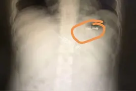 “医生快点，我的肚子要爆炸了！”宁波一男子为打赌，竟将打火机吞下肚图片