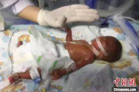 广州超早产儿出院 出生时四肢仅如成人手指般粗细图片