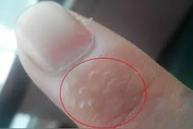 杭州姑娘一到夏天就长小水泡，奇痒难耐！最近好多人中招，无法彻底治愈图片