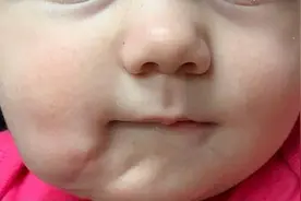 罕见！女婴长了第二张嘴，20世纪来仅35例视频封面