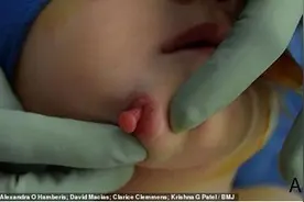 美国女婴长了两张嘴，第二张嘴中有完整的牙齿舌头，还分泌唾液图片