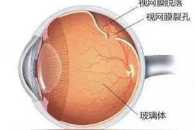 男子几近失明海上漂泊三星期，广州眼科专家竭力保视力图片