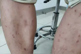 姑娘一觉睡醒身上全是小红点！这症状最近高发图片