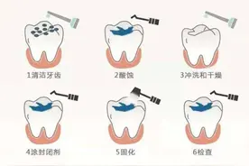窝沟封闭怎么做？有副作用吗？胶东半岛口腔医院最全解答来了图片