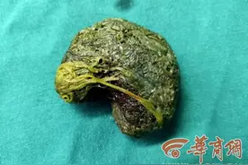 成绩不好总被家长批评压力大 12岁女孩患上异食癖连吃2年头发图片
